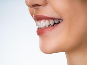 ¿Qué problemas ayudan a corregir la ortodoncia?